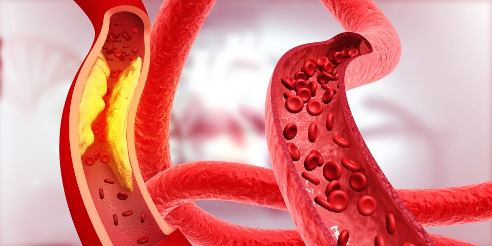اولین علائم چربی خون